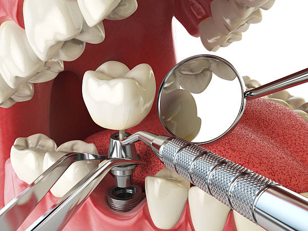 Best Broken or Cracked Tooth Emergency Dentist in Dover, FL